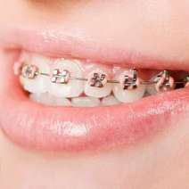Teeth braces 