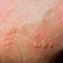  Allergic reaction of skin
